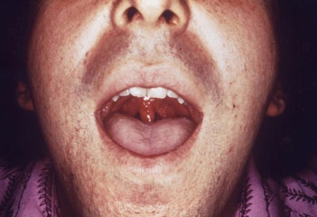 Bệnh lậu ở miệng, hầu họng do quan hệ đường miệng
